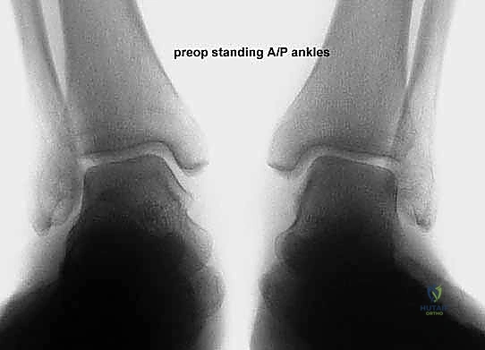 صورة توضيحية لـ إطالة العمود الجانبي للقدم