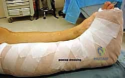 صورة طبية: إطالة العمود الجانبي للقدم: حل جراحي متقدم لتشوه القدم المسطحة المكتسبة مع الأستاذ الدكتور محمد هطيف