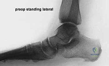 أسباب تشوه القدم المسطحة المكتسبة