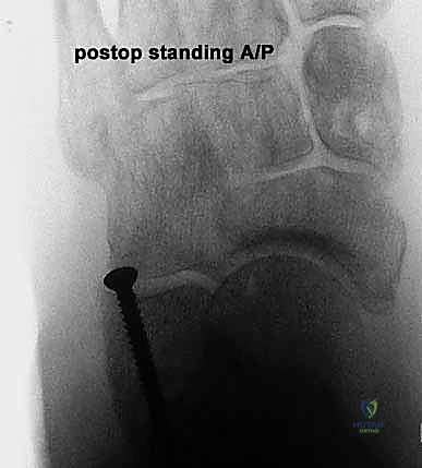 صورة طبية: إطالة العمود الجانبي للقدم: حل جراحي متقدم لتشوه القدم المسطحة المكتسبة مع الأستاذ الدكتور محمد هطيف