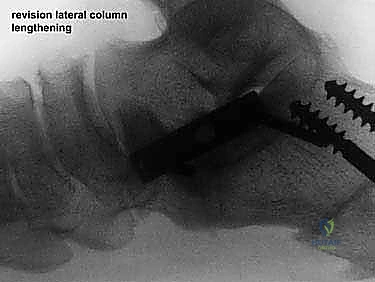 صورة طبية: إطالة العمود الجانبي للقدم: حل جراحي متقدم لتشوه القدم المسطحة المكتسبة مع الأستاذ الدكتور محمد هطيف