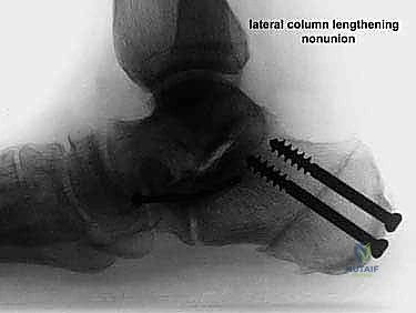 تأثير انهيار قوس القدم على الكاحل