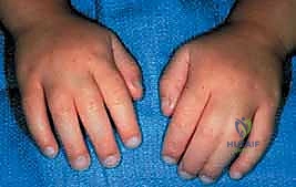 تصنيف أنواع التصاق الأصابع