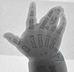 التشخيص المبكر لالتصاق الأصابع