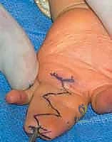 العناية باليد بعد جراحة فصل الأصابع