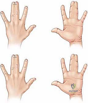 صورة توضيحية لـ جراحة فصل الأصابع الملتصقة البسيطة: دليل شامل للمرضى في صنعاء