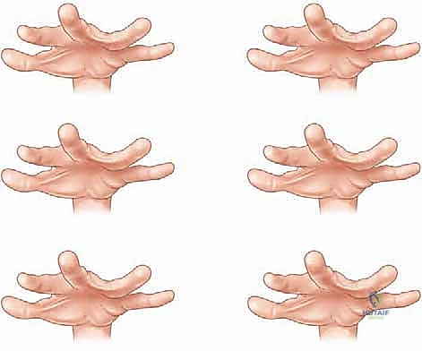 الأستاذ الدكتور محمد هطيف خبير جراحة اليد في صنعاء