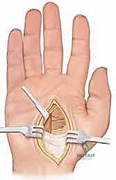 Illustration of first dorsal interosseous - Dr. Mohammed Hutaif