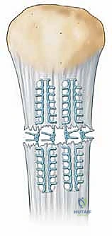 Illustration of repair of acute - Dr. Mohammed Hutaif