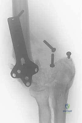 Elbow Arthroplasty Masterclass: Reconstructing Posttraumatic Elbows