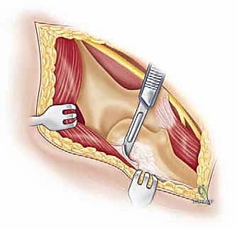 Elbow Arthroplasty Masterclass: Reconstructing Posttraumatic Elbows