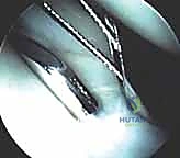 Mastering Triangular Fibrocartilage Complex (TFCC) Repair: An Intraoperative Guide