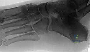 صورة توضيحية لـ علاج التحام العظم الزورقي الكاحلي عند البالغين: حلول الأستاذ الدكتور محمد هطيف في صنعاء