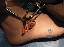 صورة توضيحية للتشريح الدقيق للقدم والتحام العظم الزورقي