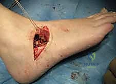 صورة للتصوير المقطعي توضح الالتحام بدقة