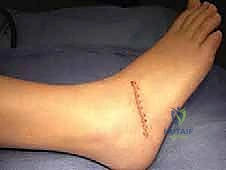 صورة توضح عملية استئصال الجسر العظمي