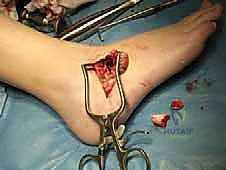 صورة توضح الشق الجراحي والوصول للالتحام