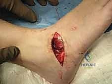 علاج التحام العظم الزورقي الكاحلي عند البالغين: حلول الأستاذ الدكتور محمد هطيف في صنعاء