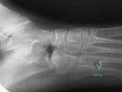 Calcaneonavicular Coalition Resection: An Adult Surgical Masterclass with EDB Interposition