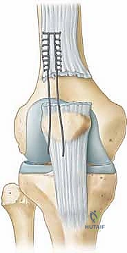 Quadriceps Tendon Repair: An Intraoperative Masterclass for Acute & Chronic Ruptures