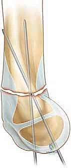Intraoperative Surgical Step