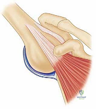 Illustration of burkhart ss lo - Dr. Mohammed Hutaif