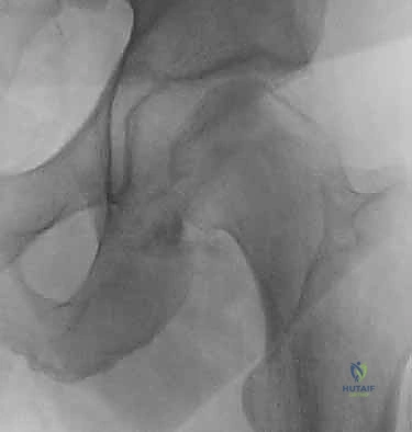 صورة توضيحية لـ كسر رأس الفخذ: دليلك الشامل للعلاج والتعافي مع الأستاذ الدكتور محمد هطيف في صنعاء