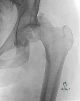 صورة توضيحية لـ كسر رأس الفخذ: دليلك الشامل للعلاج والتعافي مع الأستاذ الدكتور محمد هطيف في صنعاء
