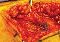 أهمية الأشعة المقطعية في تشخيص كسور رأس الفخذ