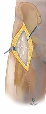 الإمداد الدموي الدقيق لرأس الفخذ