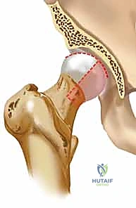 توضيح تصنيف بيبكين لكسور رأس الفخذ
