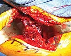 الأعراض السريرية والتشوهات المرئية لكسر رأس الفخذ