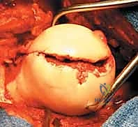 كسر رأس الفخذ: دليلك الشامل للعلاج والتعافي مع الأستاذ الدكتور محمد هطيف في صنعاء