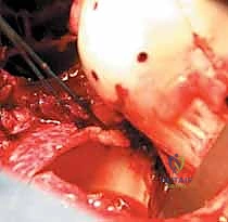 صورة توضيحية لـ كسر رأس الفخذ: دليلك الشامل للعلاج والتعافي مع الأستاذ الدكتور محمد هطيف في صنعاء