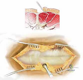 جراحات العمود الفقري الخلفية: دليلك الشامل لآلام الظهر والرقبة مع الأستاذ الدكتور محمد هطيف