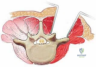 صورة توضيحية لـ جراحات العمود الفقري الخلفية: دليلك الشامل لآلام الظهر والرقبة مع الأستاذ الدكتور محمد هطيف