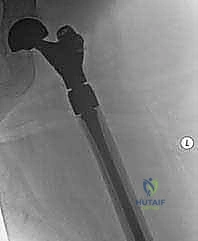 صورة طبية: استبدال مفصل الورك الكلي لآفات السرطان النقيلي: دليل شامل للمرضى في اليمن