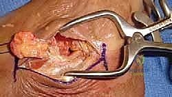 صورة توضيحية للالتحام العظمي الخلقي