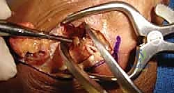 أشعة سينية توضح خشونة المفصل