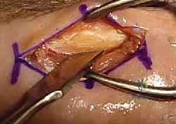 صورة توضح الشق الجراحي الدقيق