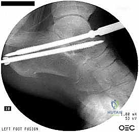 صورة توضح تثبيت العظام بالمسامير