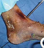 صورة توضح وضع الطعم العظمي