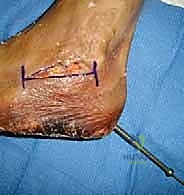 صورة توضح إزالة الغضروف وإعداد المفصل