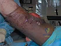 Knee Arthrofibrosis Release: An Intraoperative Masterclass for Restoring Motion