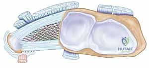 Masterclass: Extra-articular Reconstruction for DRUJ and Ulnocarpal Instability