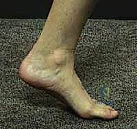 تأثير سوء التئام عظم الكعب على هيكلية القدم