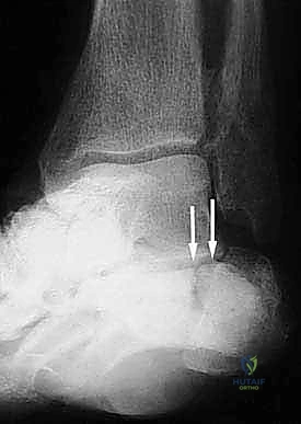 التشخيص بالأشعة المقطعية ثلاثية الأبعاد