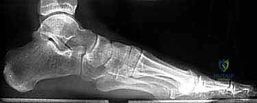 أسباب تفتت عظم الكعب والالتئام الخاطئ