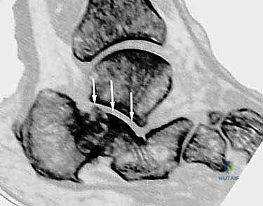 التشريح الدقيق لعظم الكعب والمفاصل المحيطة