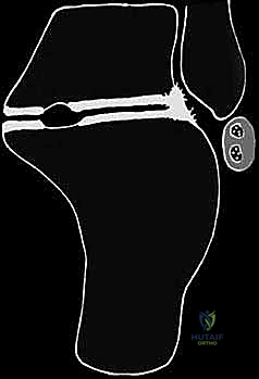 تخطيط ما قبل الجراحة باستخدام النماذج المتقدمة